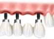 implanturi-dentare