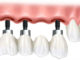 implanturi-dentare