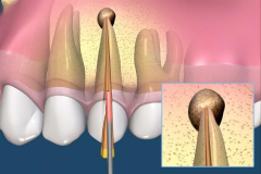 endodontie-1