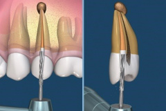 endodontie-2