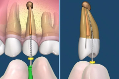 endodontie-3