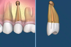 endodontie-4