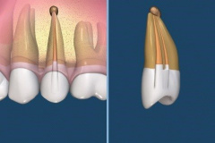 endodontie-5