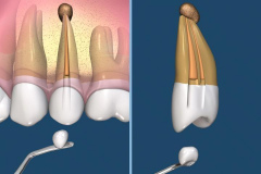 endodontie-6