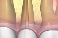 endodontie-7