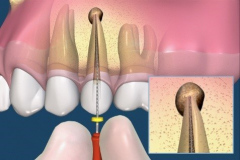 endodontie