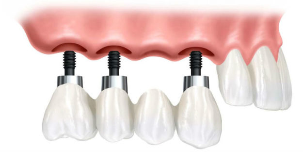 implanturi-dentare implanturi-dentare