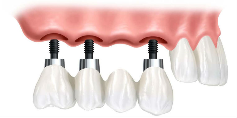implanturi-dentare implanturi-dentare