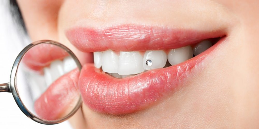 bijuterii dentare